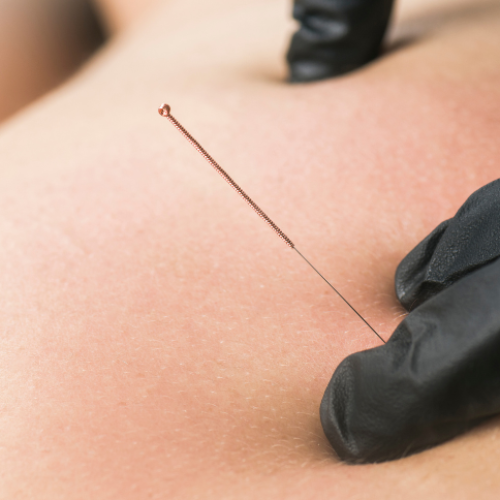Dry Needling 2